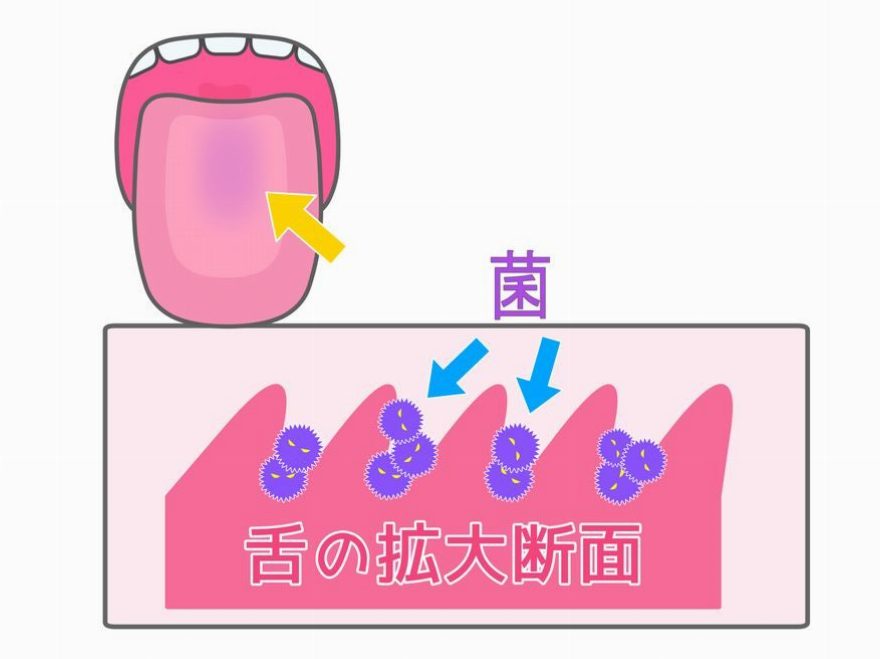 口臭の原因にもなる舌苔ってなに？