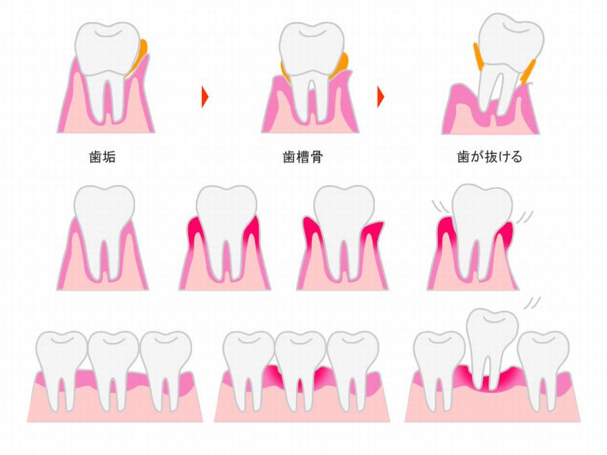 歯周病があると口臭が起こる